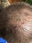 Болячки на волосистой части головы фото 1