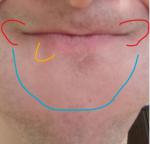 Краснота на уголках губ, около крыльев носа, ниже нижней губы фото 1
