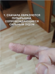 Распространяющаяся инфекция с очагом на пальце руки фото 1