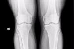 Травма коленных суставов фото 1