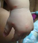 Розовые пятна на руках и ногах у ребенка 9 месяцев фото 1