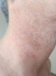 Раздражение кожи на шее и груди после бритья фото 1