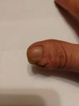 Коррекция ногтевой пластины фото 1