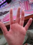 Красные круглые болячки на пальцах рук фото 1