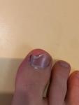 Лечение грибка ногтя на ноге фото 1