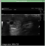 Киста левого яичника и варикоцеле фото 1