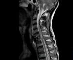 Сможет ли встать на ноги после травмы спинного мозга (МРТ) фото 1