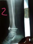 Перелом голеностопа левой б/берцовой кости фото 2