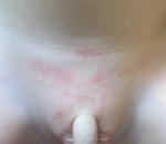 Аллергия или контактный дерматит у ребёнка фото 1