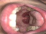 Жжение в горле, сильная боль при глотании фото 2