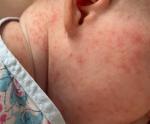 Воспалённые высыпания у ребёнка на лице/шее и груди фото 1