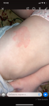 Пятна у ребенка аллергия или нет фото 1