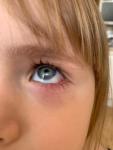 Воспаление глаза у ребёнка 4 лет фото 2