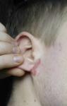 Раздражение кожи около мочки уха. Фото фото 1