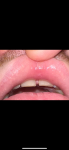Что за нарост на слизистой верхней губы? фото 2