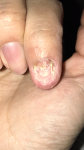 Дрожжевой грибок ногтя при ГВ фото 3