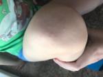 Сыпь у ребенка по телу фото 2