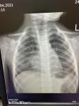 Пневмония или нет в сегменте s8 правое лёгкое фото 2