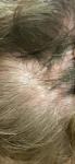 Зуд кожи головы и выпадение волос фото 1