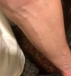 Шарики на венах на внутренней строне рук после вакцинации фото 3