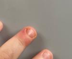 Воспаление и покраснение пальчика руки фото 4