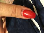 Трещина ногтевой пластины в лунке ногтя. Повышена чувствительрость. Чем лечить? фото 1