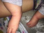Атопический дерматит у 3-месячного ребенкао фото 2