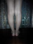 Варусные ноги фото 2