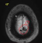 МРТ головного мозга, помогите разобраться (седло, сосудистая патология и инфаркт) фото 2