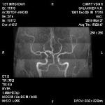 Результаты МРТ вен. Нарушение венозного оттока фото 3