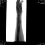 Перелом лучевой кости фото 1
