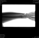 Перелом лучевой кости фото 2