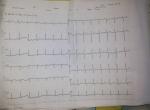 Расшифровка кардиограммы с ИВР фото 5