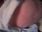 Красные шелушащиеся пятна на груди у трехмесячного малыша фото 1