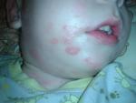 Пятна на лице и сыпь на теле у ребенка фото 1