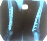 Перелом левой плечевой кости в н/3 со смещением фото 2