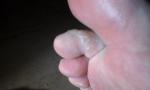 Водянистые высыпания в виде пузырьков между пальцами ног фото 1