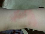 Аллергия на укусы комаров фото 1
