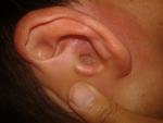Боли в ушах отек, гной, белые язвочки или прищи фото 1
