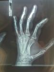 Перелом со смещением второй пястной кисти левой руки фото 2