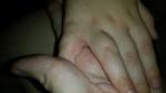 Сыпь между пальцами рук фото 1