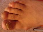 Грибок ногтей - больших ногтей ног фото 1