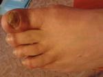 Грибок ногтей - больших ногтей ног фото 2