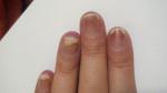 Ногти отходят от ногтевого ложа фото 1