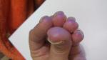 Ногти отходят от ногтевого ложа фото 2