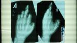 Эндопротез сустава пальца фото 1