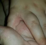 Сыпь между пальцами рук фото 2