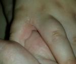 Сыпь между пальцами рук фото 3