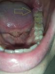 Вздутие десны со стороны языка последнего зуба фото 1