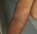 Шелушение и пупырышки на пальце фото 3